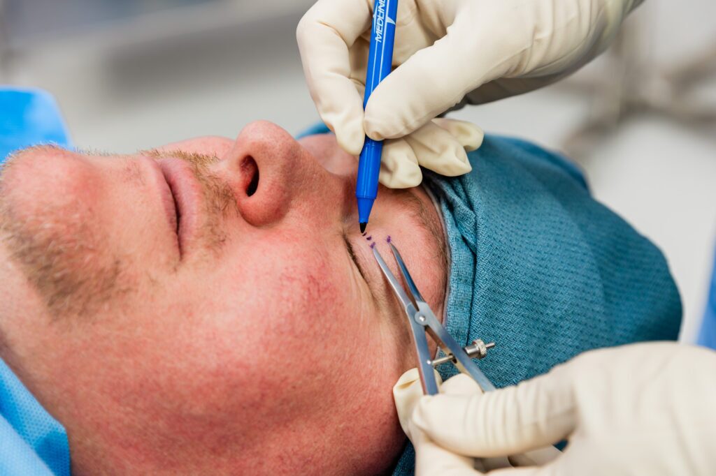 A Look at Blepharoplasties