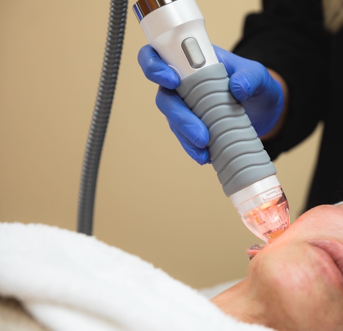 The Atlanta Glow-Up: How to Get Red-Carpet Radiance With Microneedling