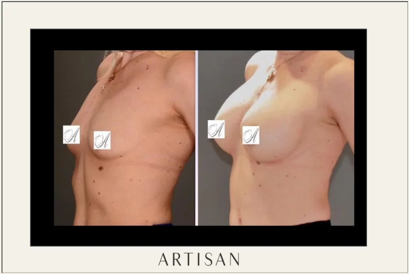 What does breast implant size in CC actually mean?