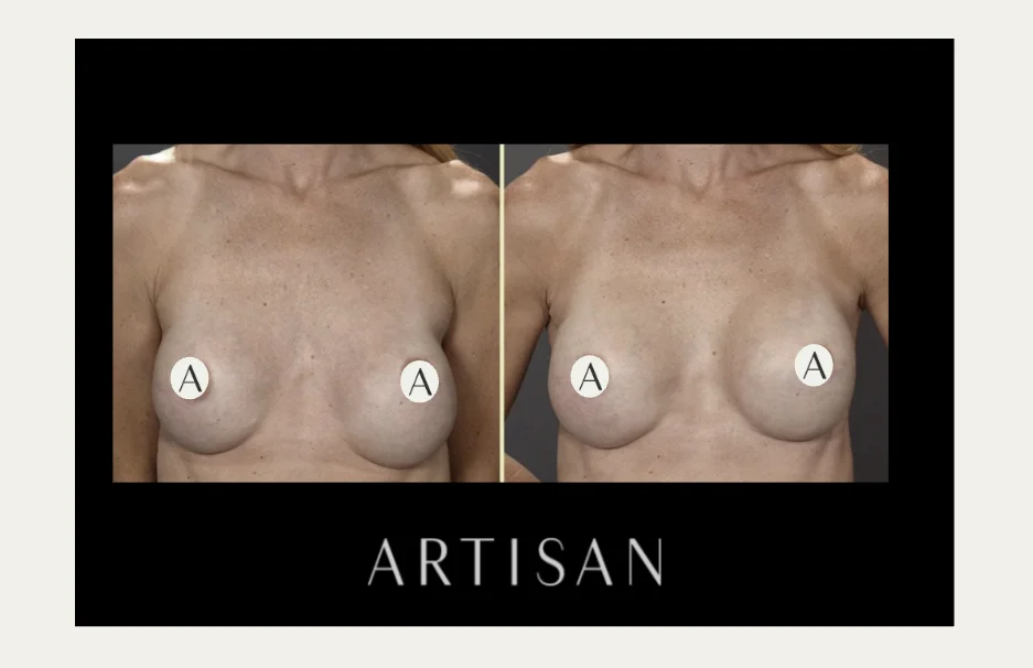 Breast Implant Revision: What to Know Before You Decide