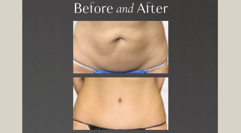 How Is a Tummy Tuck Performed? A Step-by-Step Walkthrough