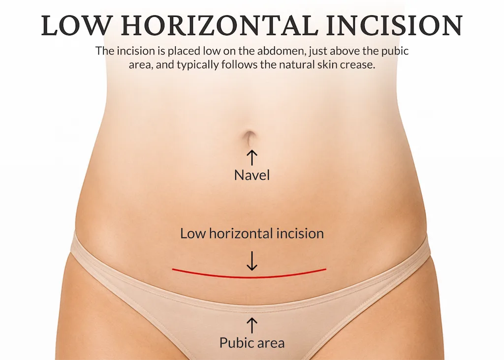 How and where does the surgeon make incisions for a tummy tuck?