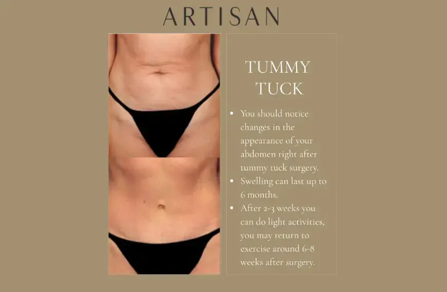 What is recovery like after a tummy tuck?