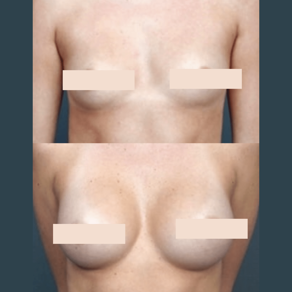 Is Breast Augmentation Right for Me?