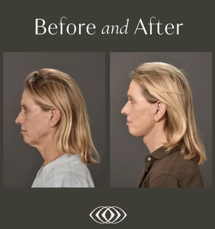 How do cost considerations and candidacy differ for full versus targeted facelifts?