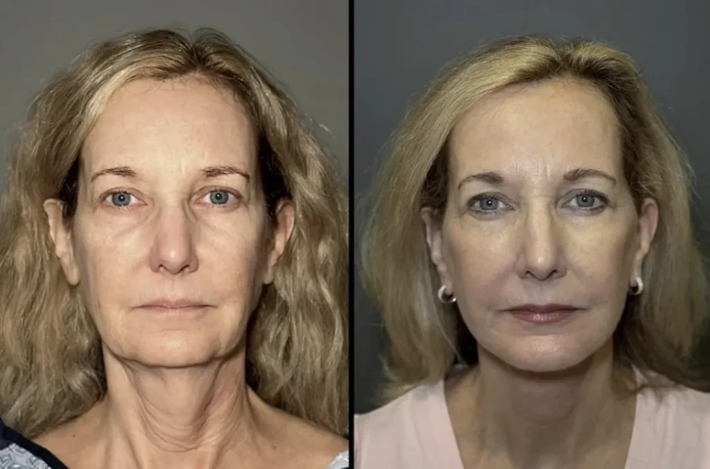 What Results Can You Realistically Expect from a Facelift?
