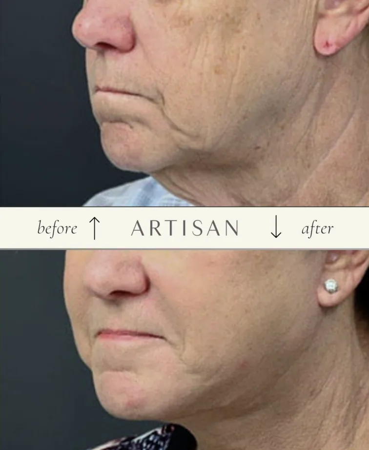 What are targeted or mini facelifts, and what do they treat?