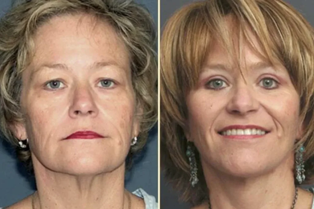When Do Facelift Results Fully Appear?