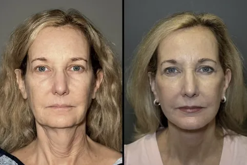 How Does Your Surgeon's Approach Affect Natural-Looking Results?