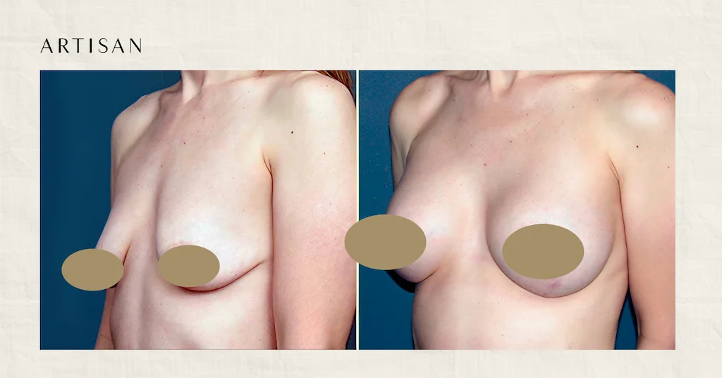 Breast Augmentation Results: What to Realistically Expect
