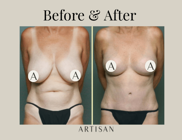 mommy makeover before and after - artisan plastic surgery - real patient
