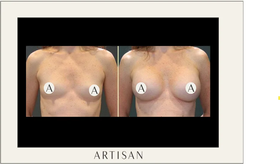How does your surgeon place and position the implants?
