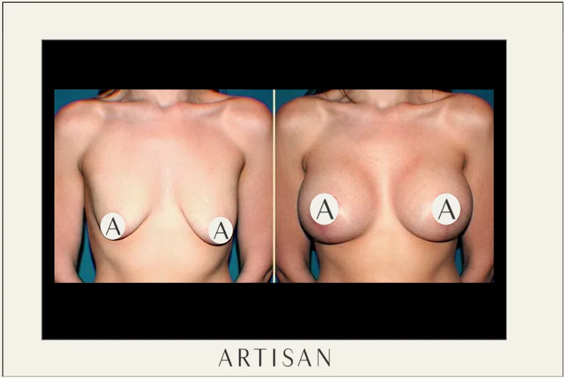 Where will your surgeon make the incision?