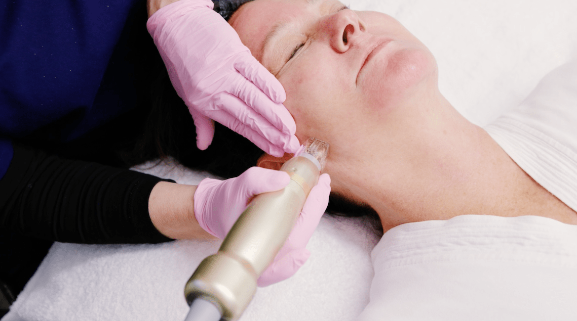 A female patient relaxes on a treatment table as an Artisan provider uses the Sylfirm X device to perform Atlanta microneedling on the patient's cheek.