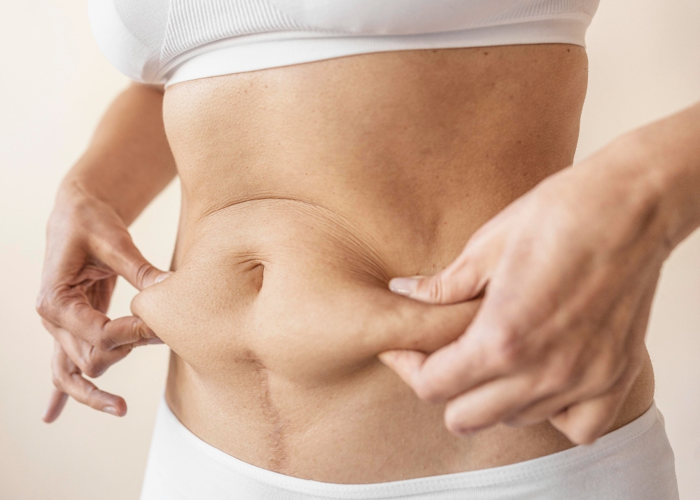 A woman pinches her excess fat as she considers a tummy surgery near Johns Creek