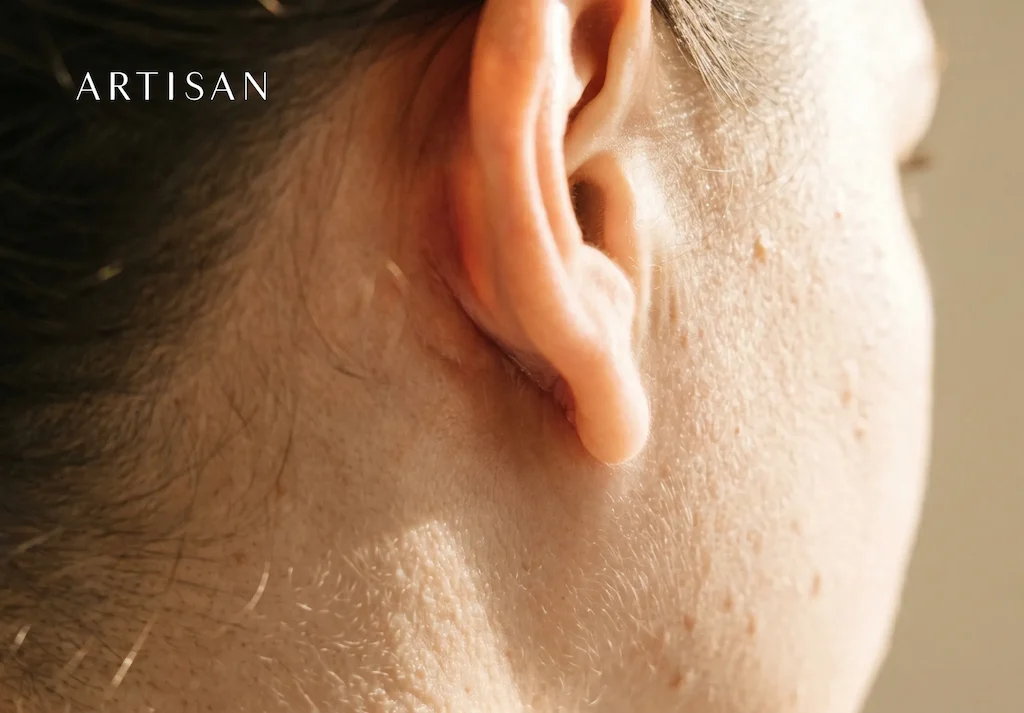 What are the risks and long-term results of otoplasty?