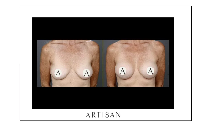 Breast Lift With Implants: Size, Scars, and Recovery