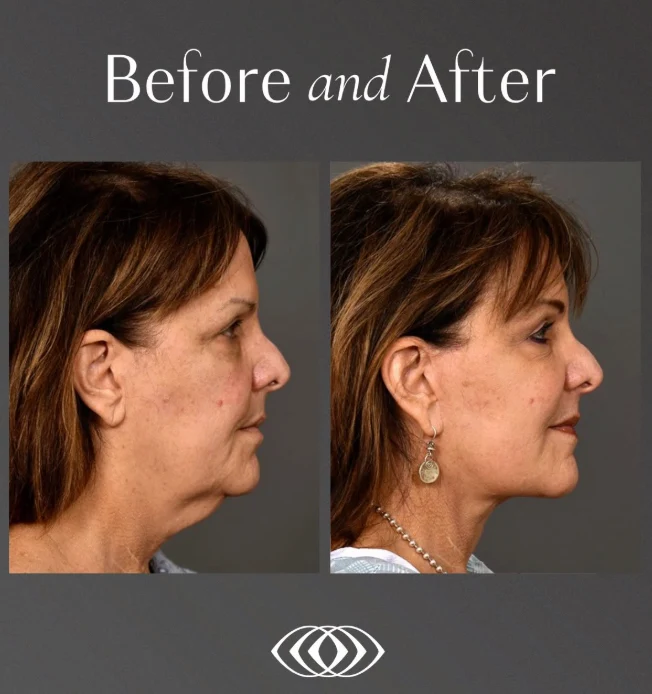 How are upper, midface, and lower lifts actually performed?